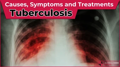 Tuberculosis article header – First Aid Article in Narre Warren